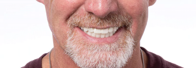 Close-up of a man's smile showing natural-looking zirconia dental implants.