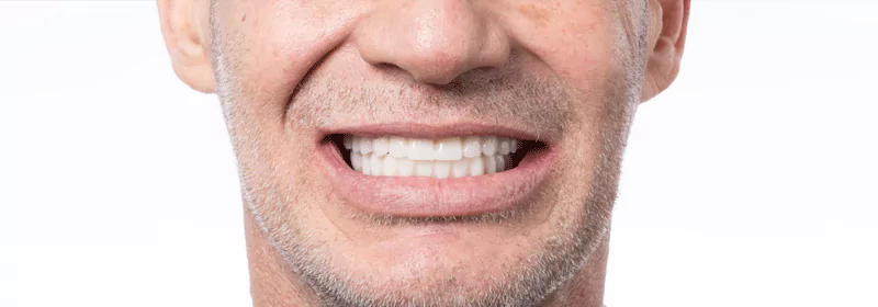 Close-up of a man smiling with zirconia dental implants on upper and lower arches.