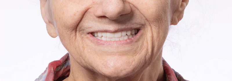 Elderly woman smiling with full-arch zirconia dental implants.
