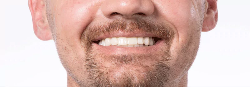 Close-up of a man smiling with newly placed zirconia dental implants.