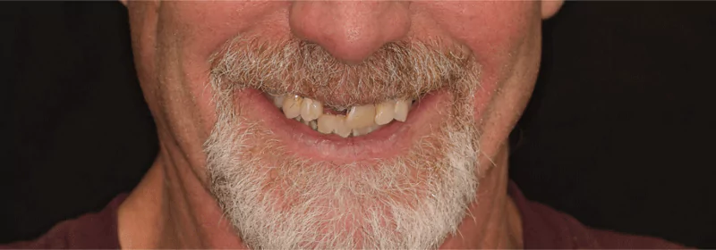 Close-up of a man with missing and broken teeth before dental treatment.