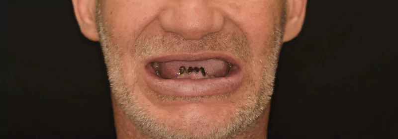 Close-up of a man's mouth showing four dental implant abutments on the lower jaw.