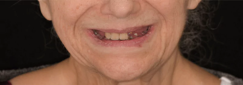 Elderly woman with multiple missing and decayed teeth before dental treatment.
