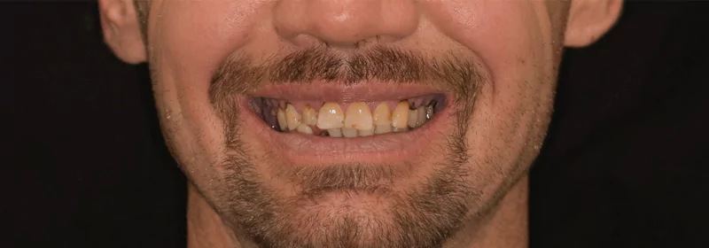 Male patient with discolored and misaligned teeth before full mouth restoration.